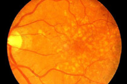 Возрастная потеря зрения связана с дефектом двух генов