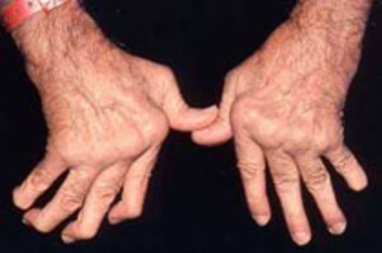 Ревматоидный артрит способствует развитию рака